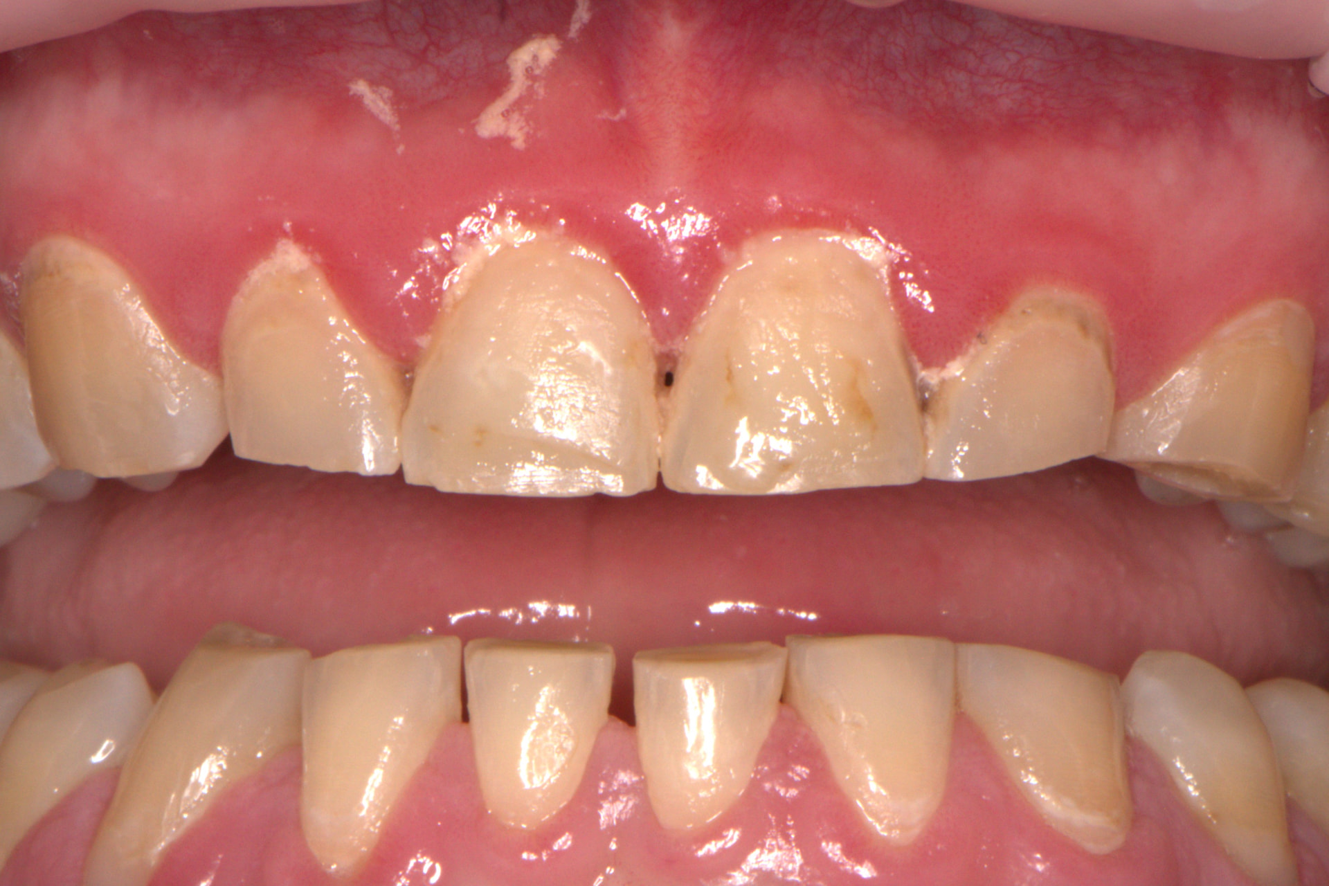 Veneers for Severe Bruxism — before