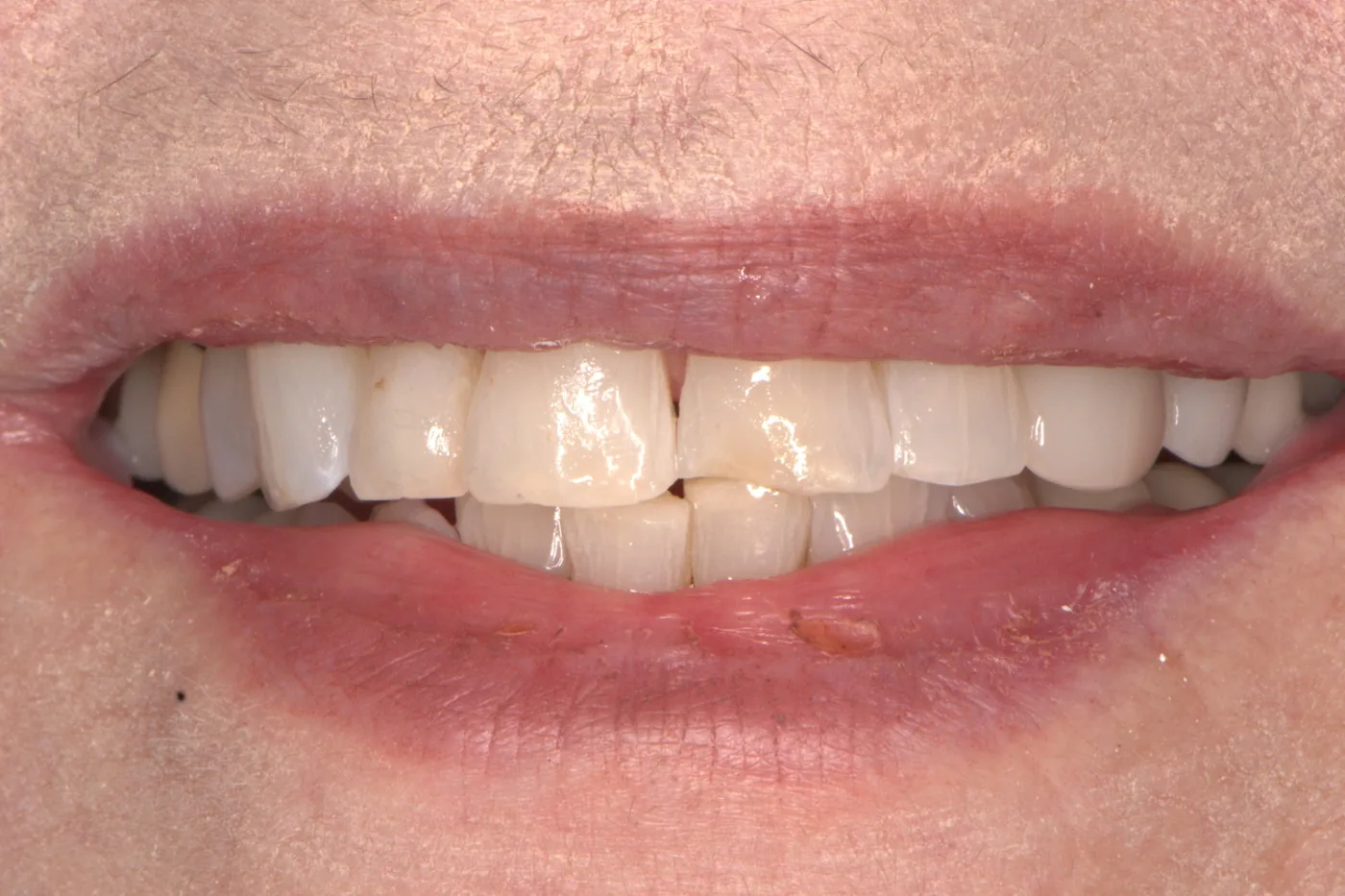 Chipped Tooth Repair — before