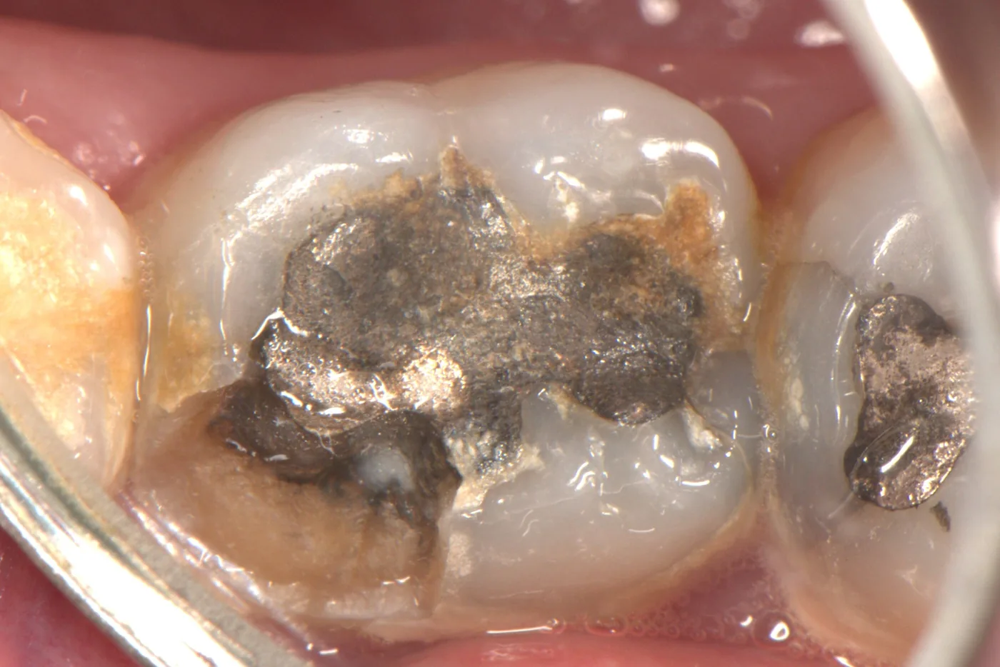 Mercury-Free Amalgam Removal — before