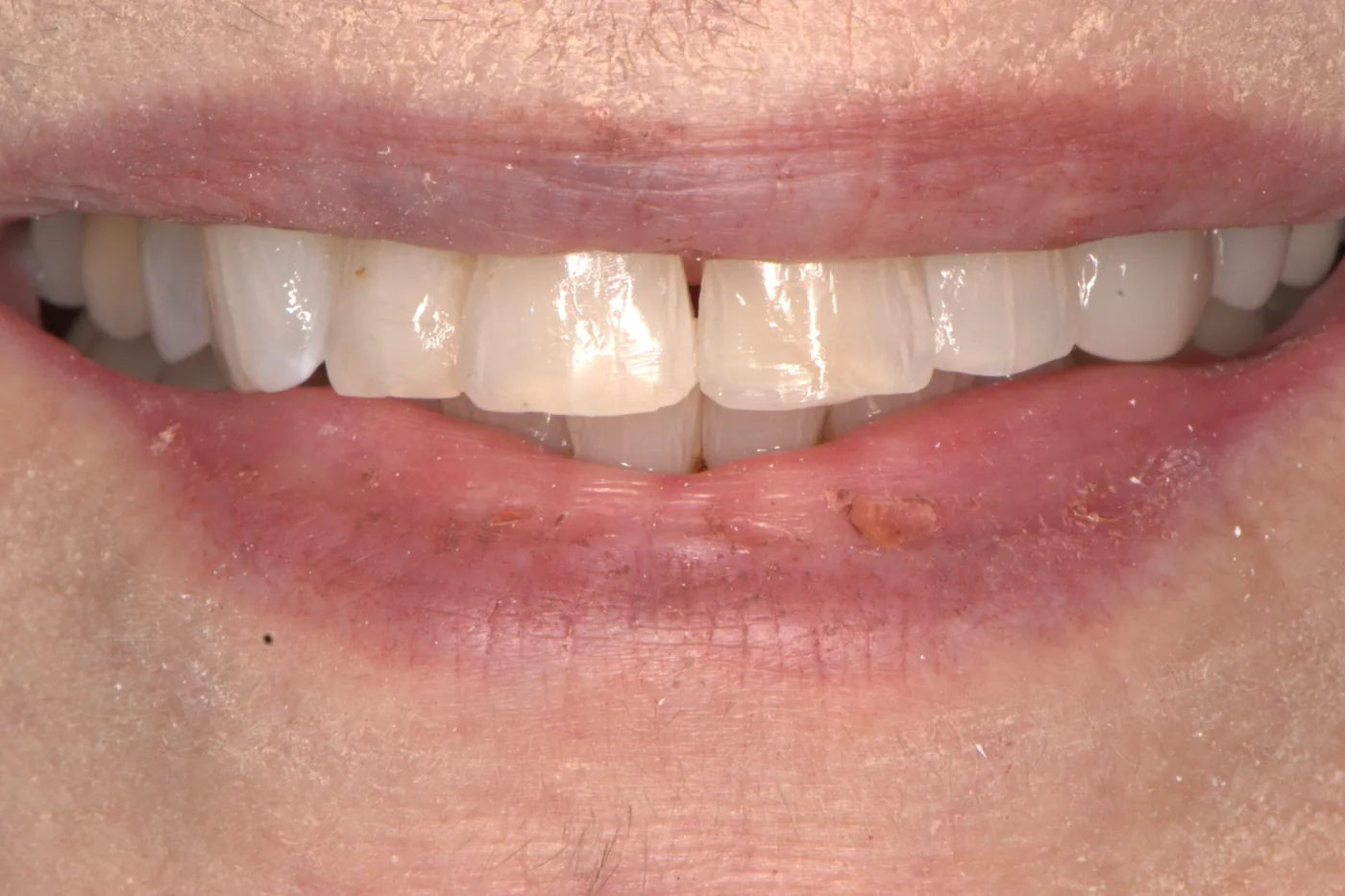 Chipped Tooth Repair — after