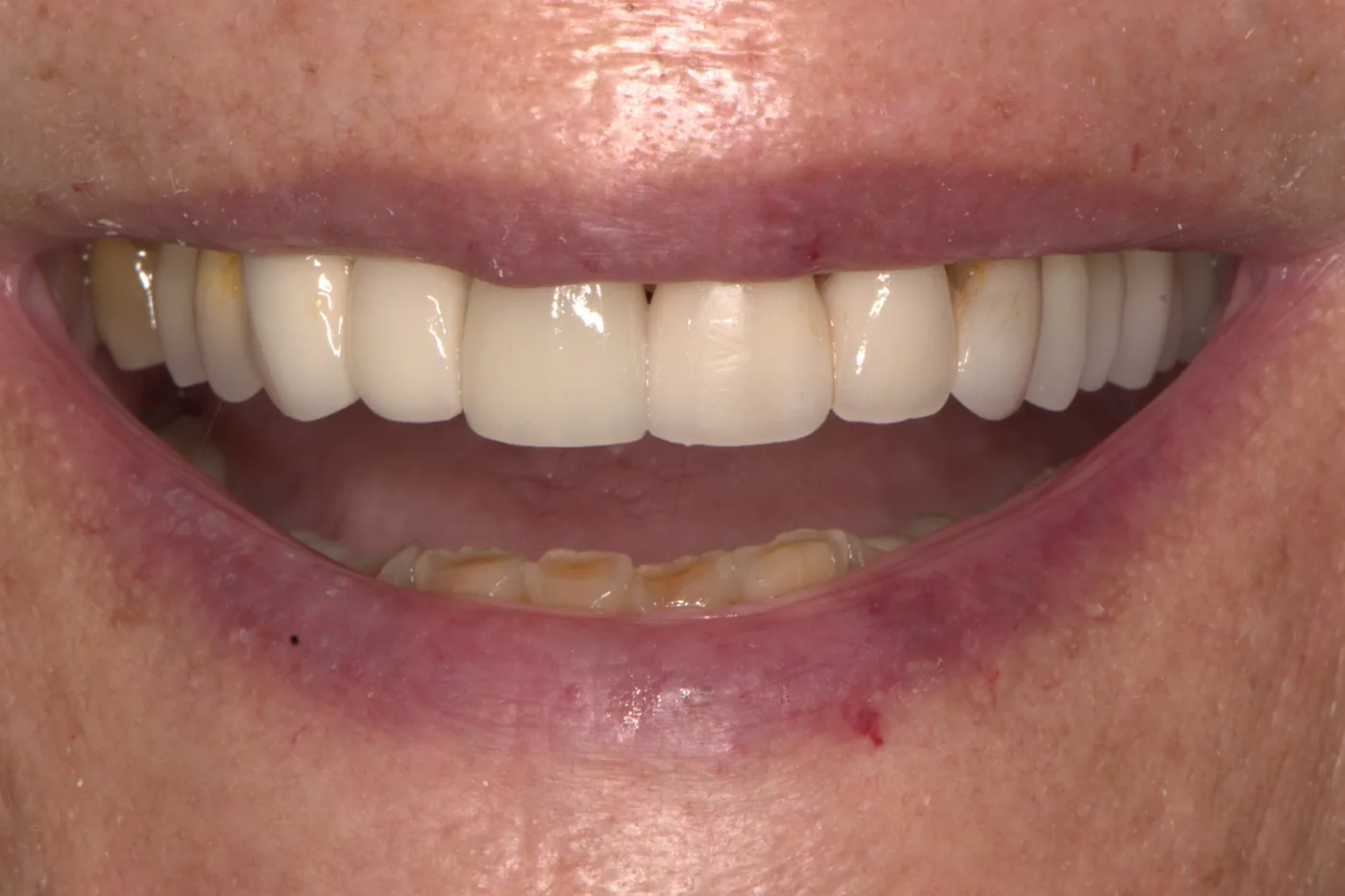 Full Smile Reconstruction — after
