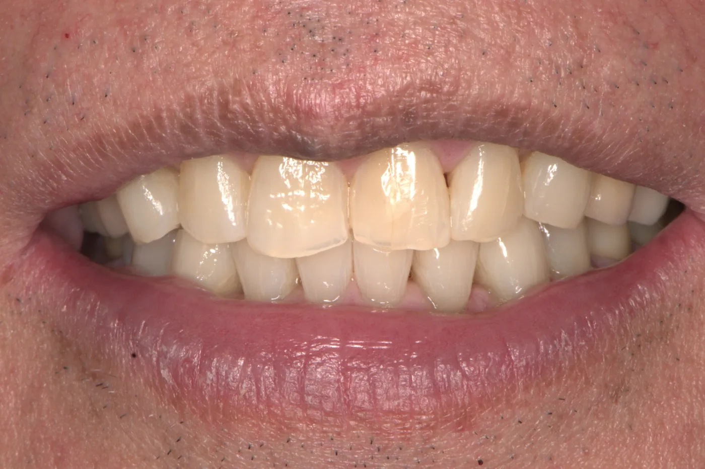 Professional Teeth Whitening — after