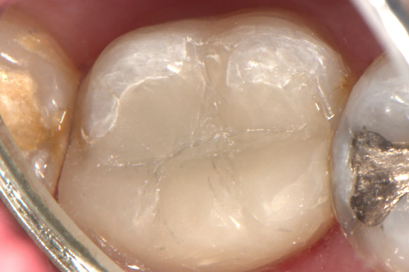 Mercury-Free Amalgam Removal — after