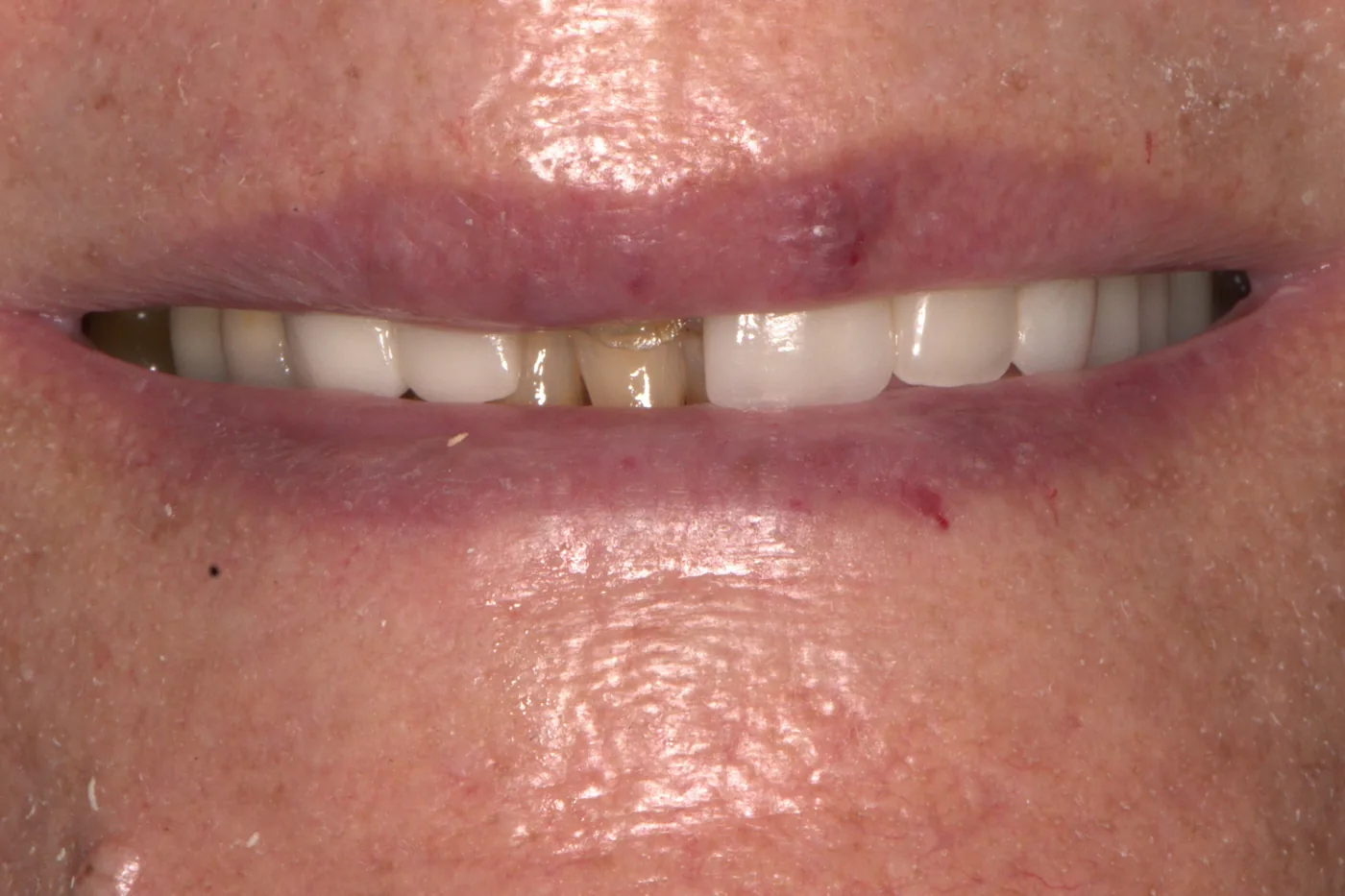 Full Smile Reconstruction — before