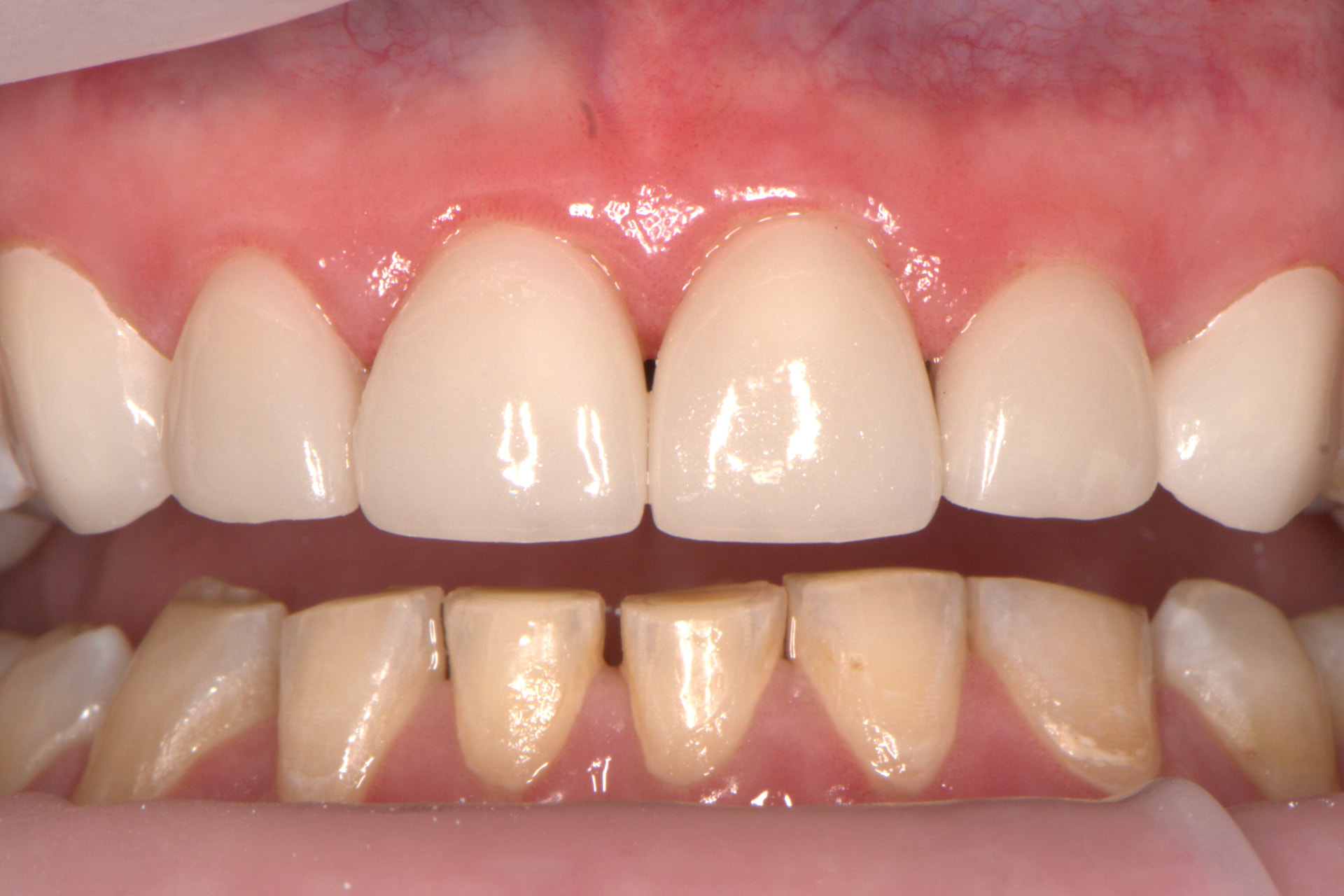 Veneers for Severe Bruxism — after
