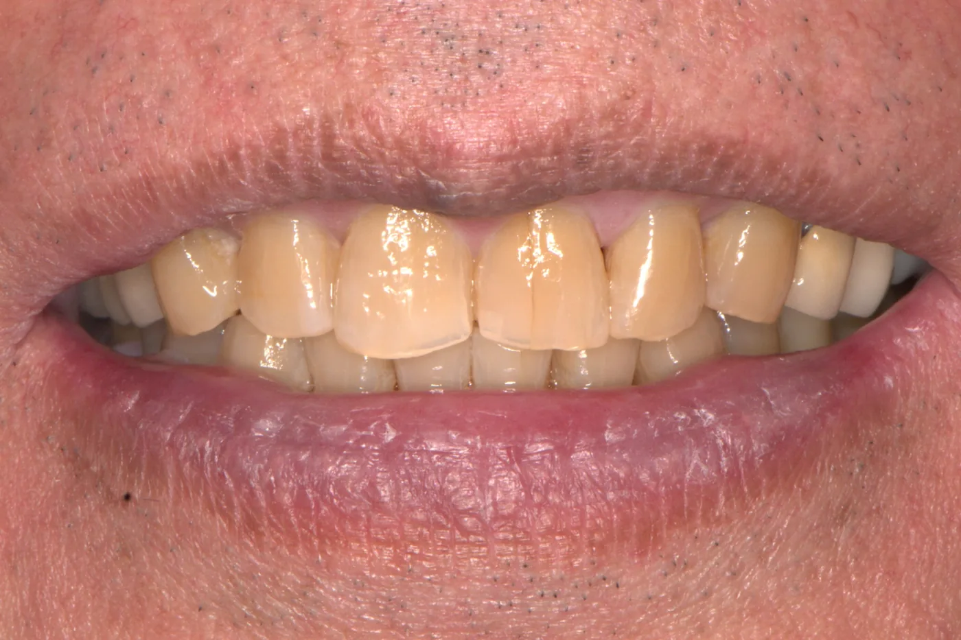 Professional Teeth Whitening — before