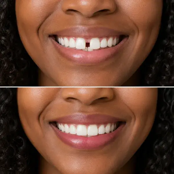 Gap closure