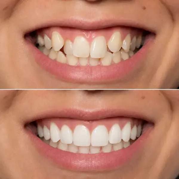 Invisalign pre-alignment