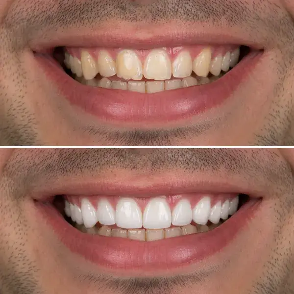 Porcelain veneers