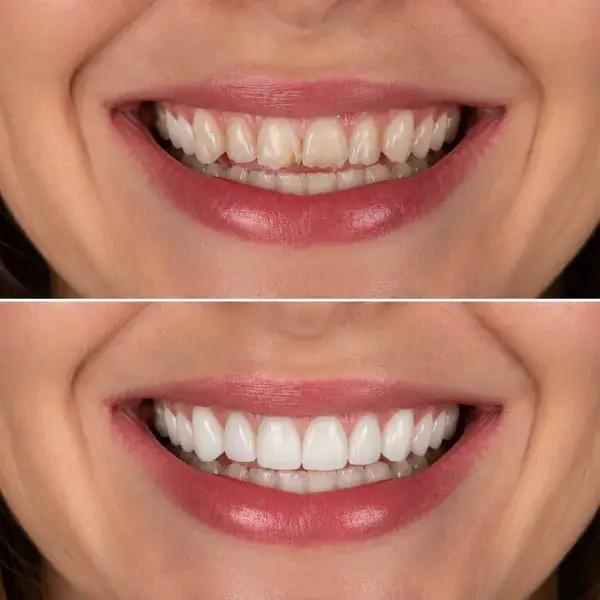 No-prep veneers